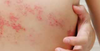 Gürtelrose ansteckend